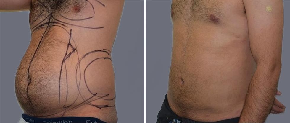 Mega Vaser Liposcution Male Pre2024 022 Before And After