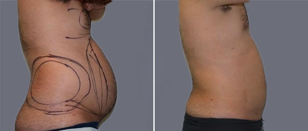 Mega Vaser Liposcution Male Pre2024 023 Before And After