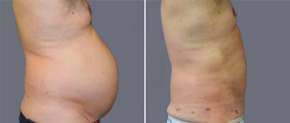 Mega Vaser Liposcution Male Pre2024 024 Before And After