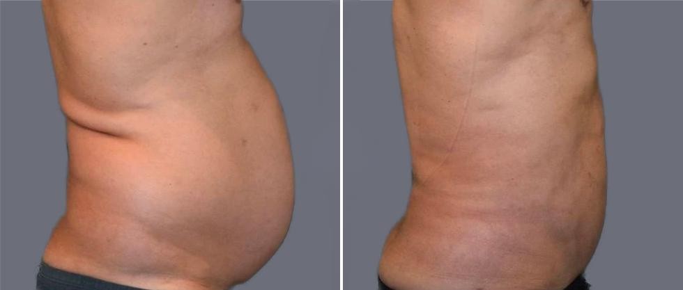 Mega Vaser Liposcution Male Pre2024 025 Before And After