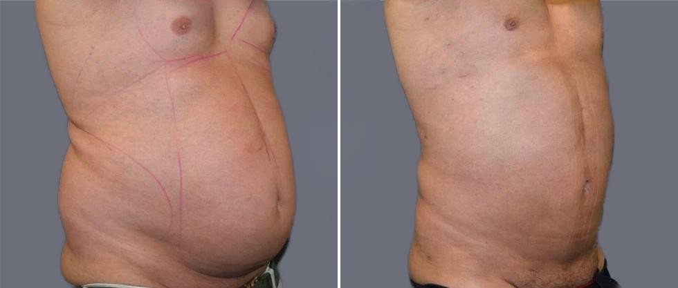 Mega Vaser Liposcution Male Pre2024 026 Before And After