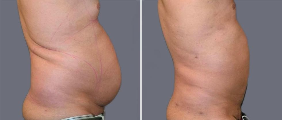 Mega Vaser Liposcution Male Pre2024 027 Before And After