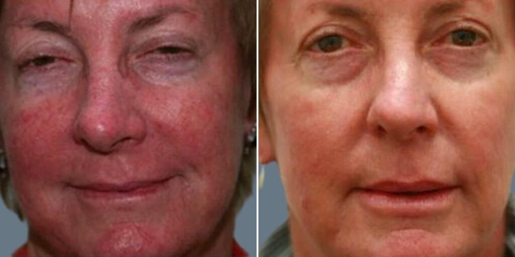 Skin Acne Capillaries Rosacea Female Pre2024 001 Before And After