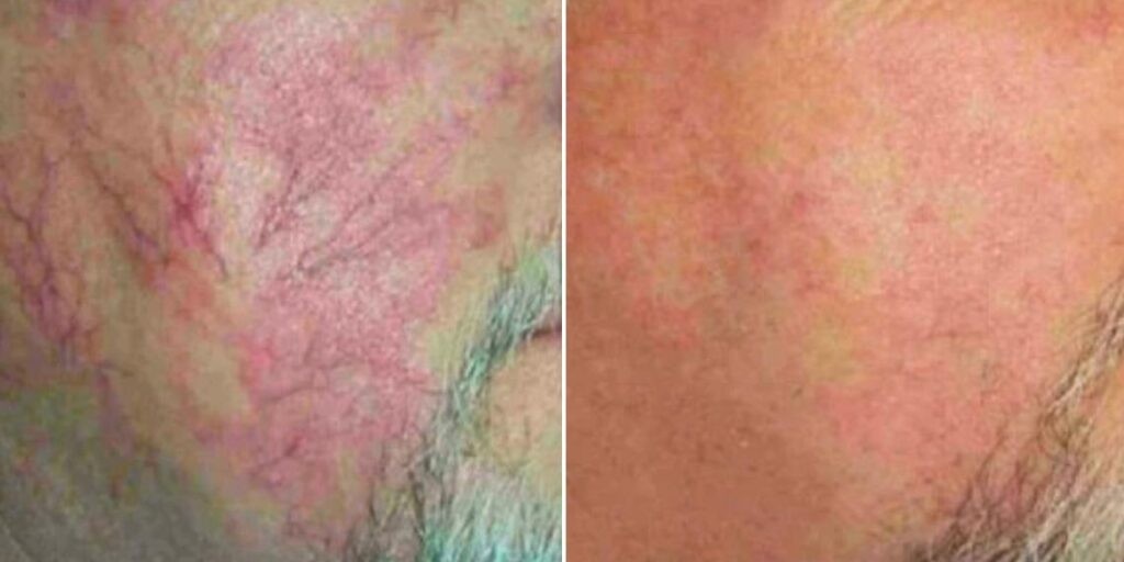 Skin Acne Capillaries Rosacea Female Pre2024 002 Before And After