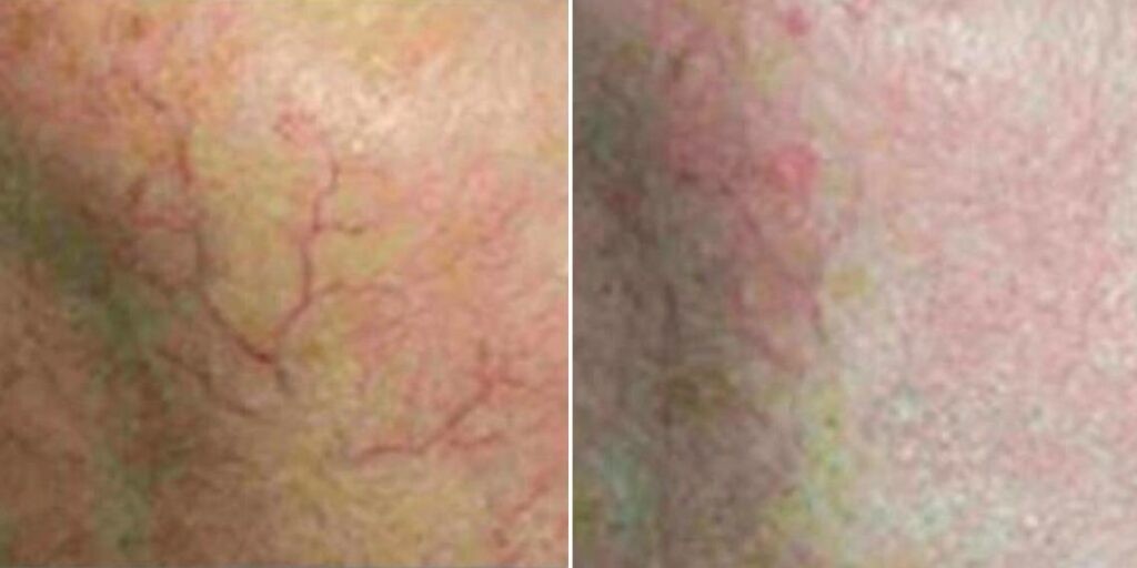 Skin Acne Capillaries Rosacea Female Pre2024 003 Before And After