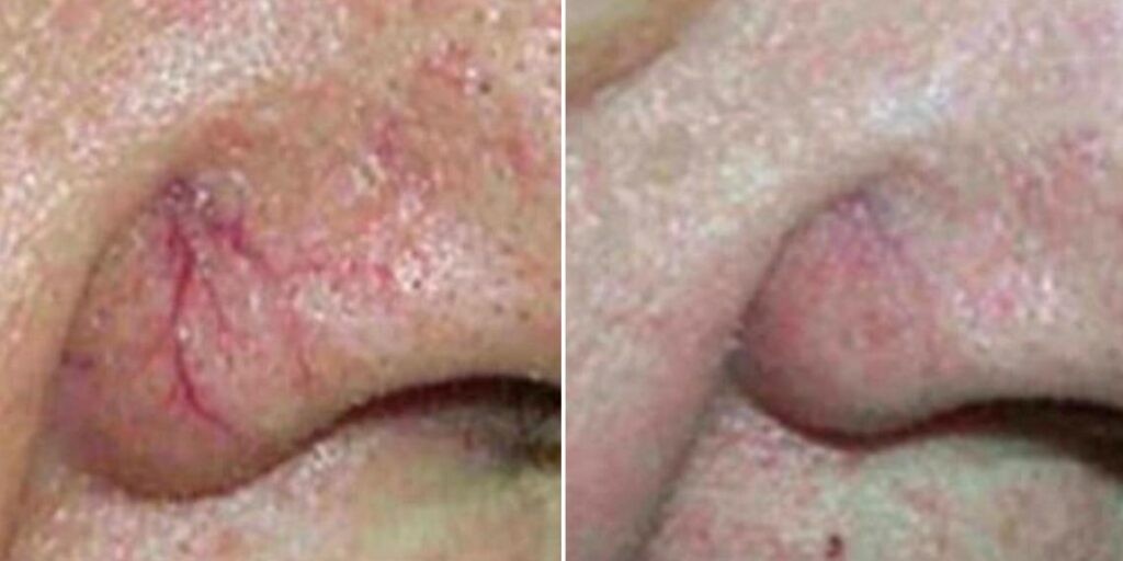 Skin Acne Capillaries Rosacea Female Pre2024 004 Before And After