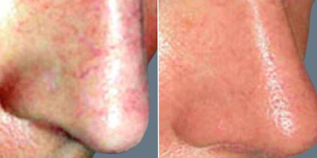 Skin Acne Capillaries Rosacea Female Pre2024 005 Before And After