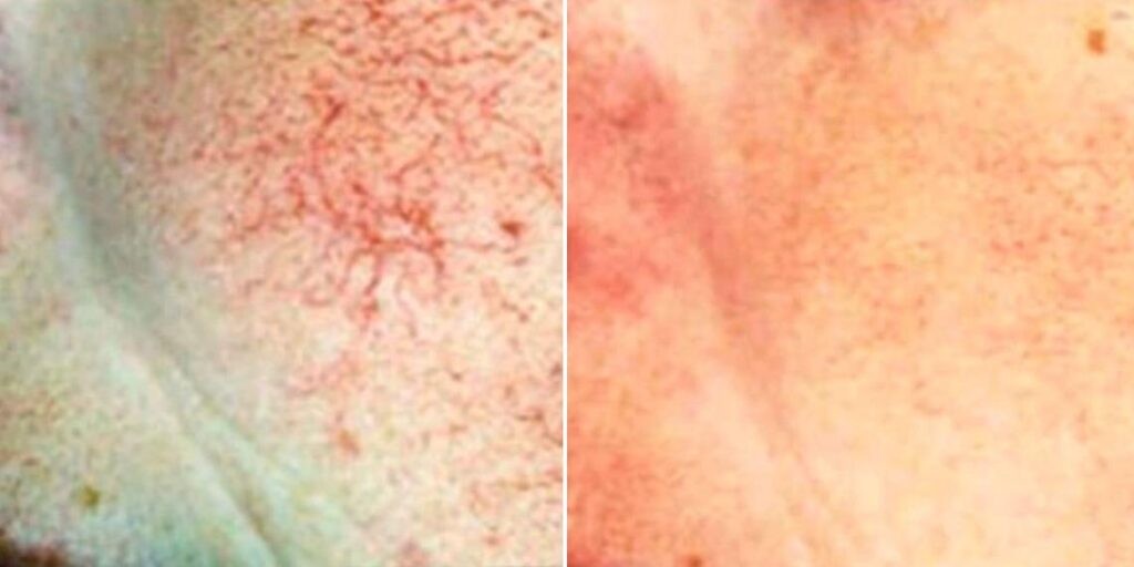 Skin Acne Capillaries Rosacea Female Pre2024 006 Before And After