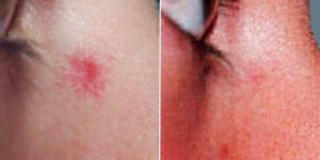 Skin Acne Capillaries Rosacea Female Pre2024 007 Before And After