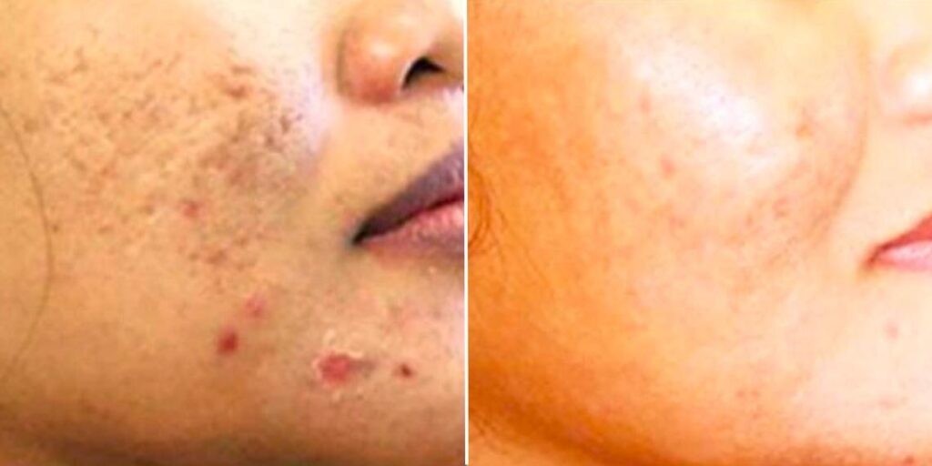 Skin Acne Scars Female Pre2024 001 Before And After