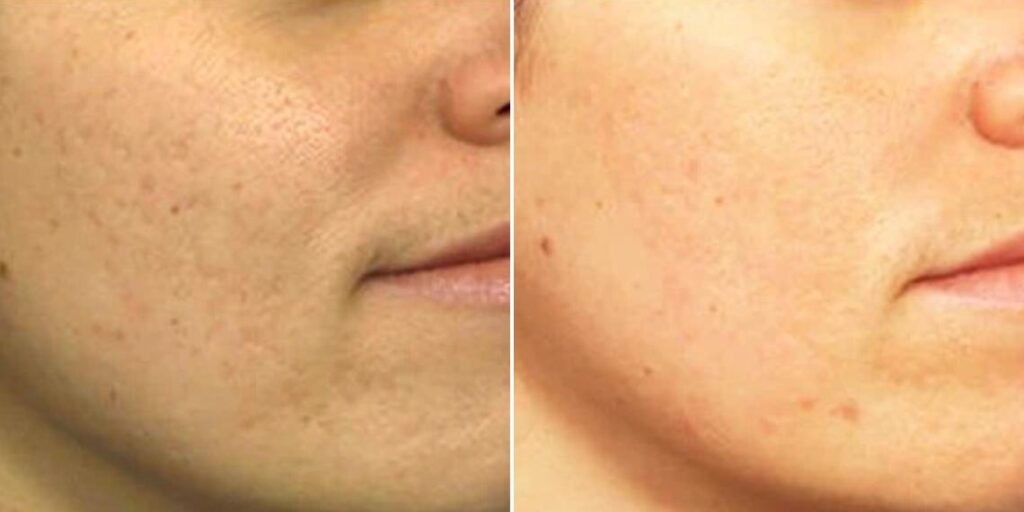 Skin Acne Scars Male Pre2024 002 Before And After
