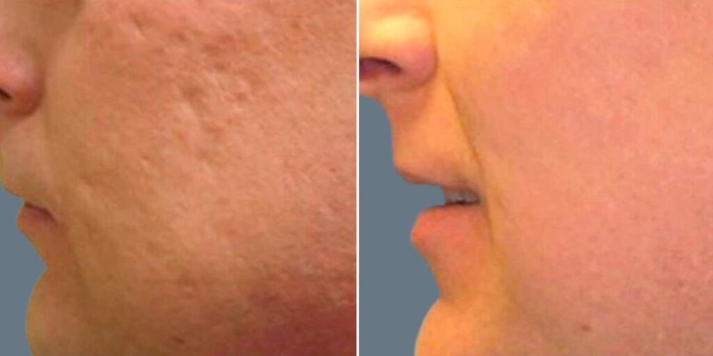 Skin Acne Scars Male Pre2024 003 Before And After
