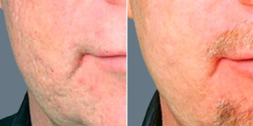 Skin Acne Scars Male Pre2024 004 Before And After