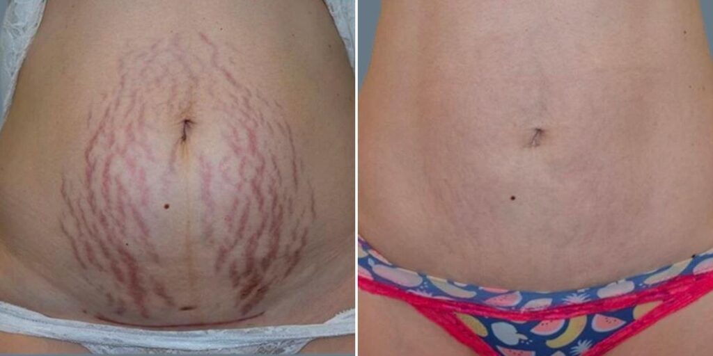 Skin Acne Skin Needling Female Pre2024 001 Before And After