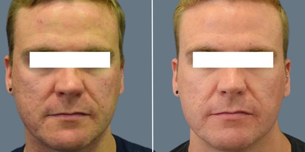 Skin Acne Skin Needling Male Pre2024 002 Before And After