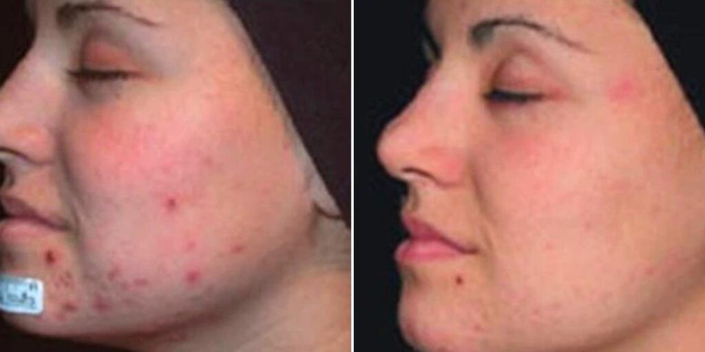 Skin Acne Treatment Female Pre2024 001 Before And After