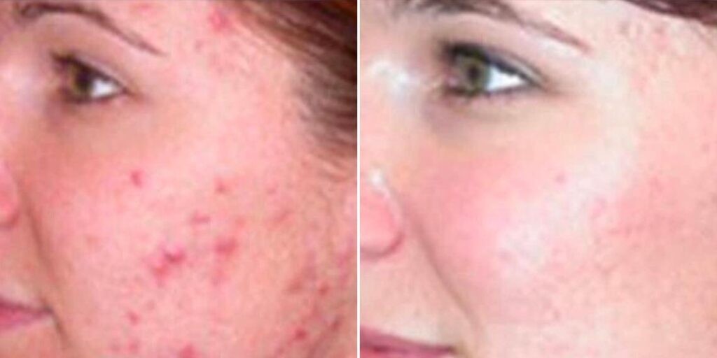 Skin Acne Treatment Female Pre2024 002 Before And After