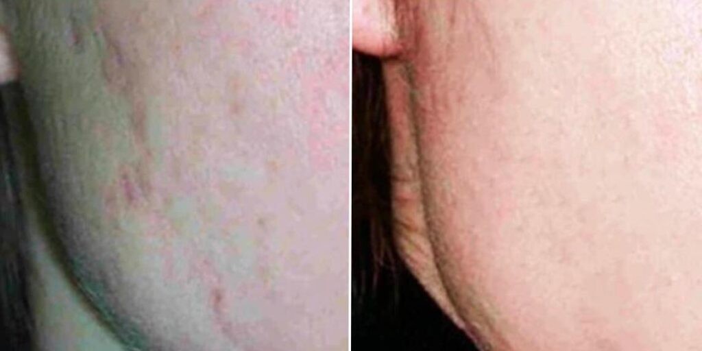 Skin Acne Treatment Female Pre2024 003 Before And After