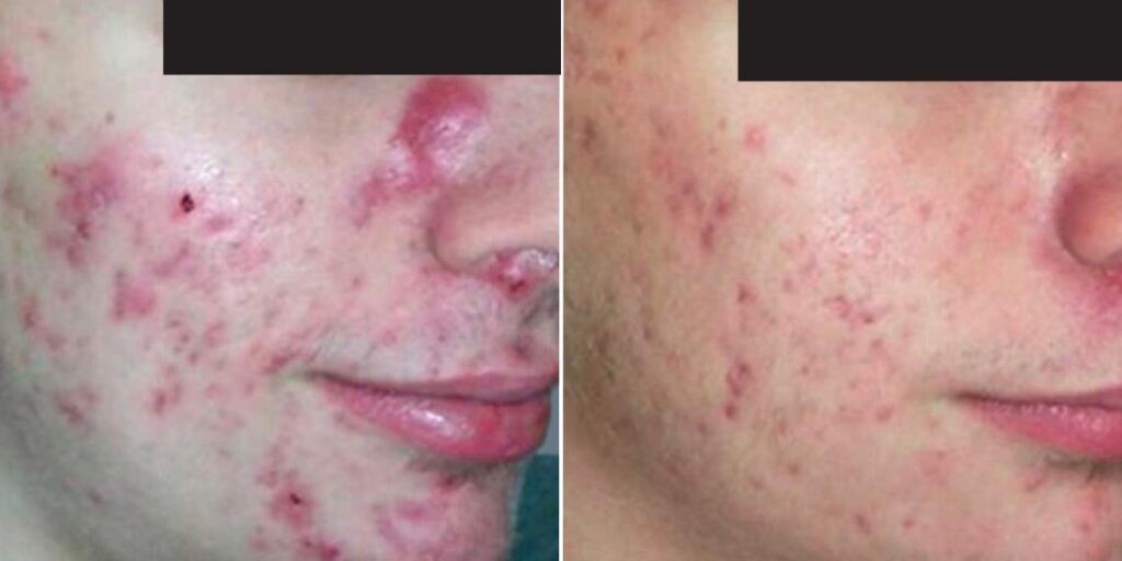 Skin Acne Treatment Male Pre2024 004 Before And After