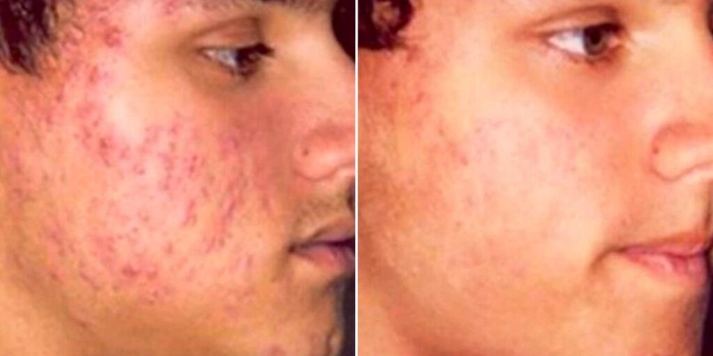 Skin Acne Treatment Male Pre2024 005 Before And After