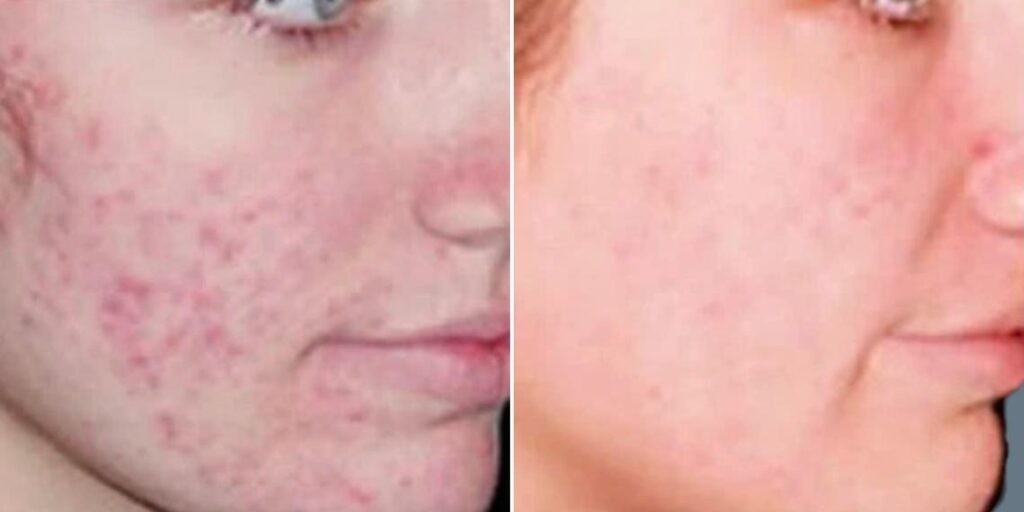 Skin Acne Treatment Male Pre2024 006 Before And After