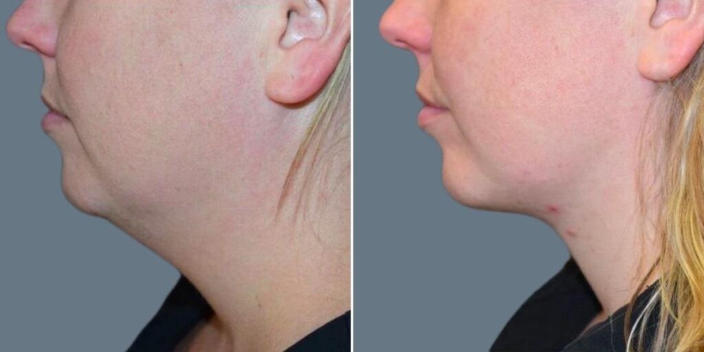 Skin Neck Liposuction Lift Female Pre2024 001 Before And After