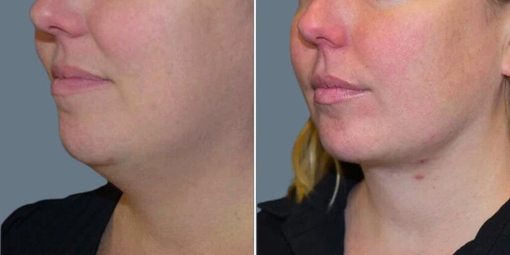 Skin Neck Liposuction Lift Female Pre2024 002 Before And After