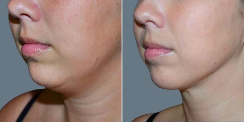 Skin Neck Liposuction Lift Female Pre2024 003 Before And After