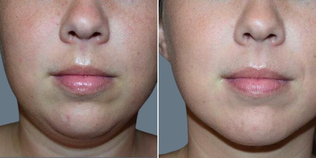 Skin Neck Liposuction Lift Female Pre2024 004 Before And After