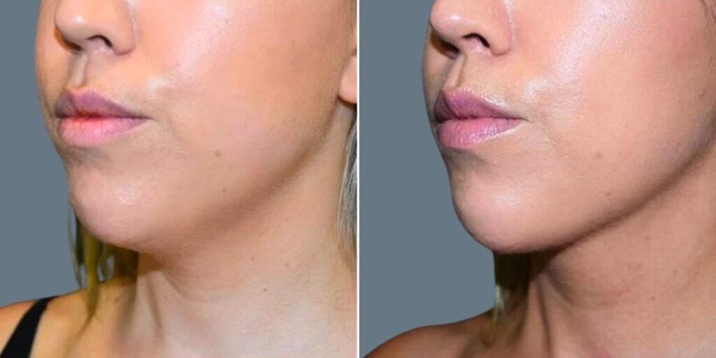 Skin Neck Liposuction Lift Female Pre2024 005 Before And After