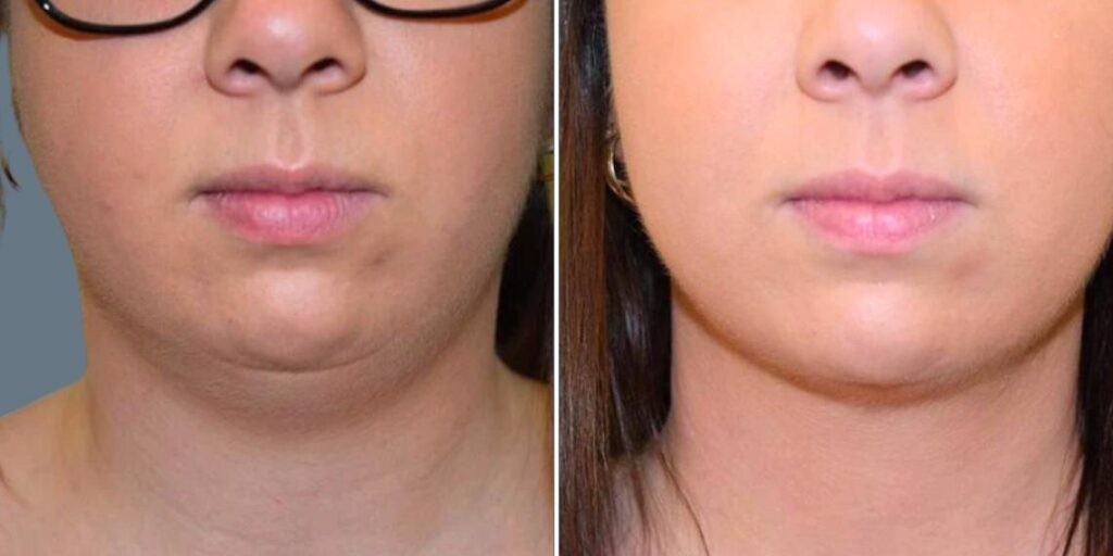 Skin Neck Liposuction Lift Female Pre2024 006 Before And After