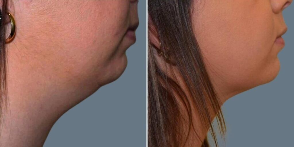 Skin Neck Liposuction Lift Female Pre2024 007 Before And After