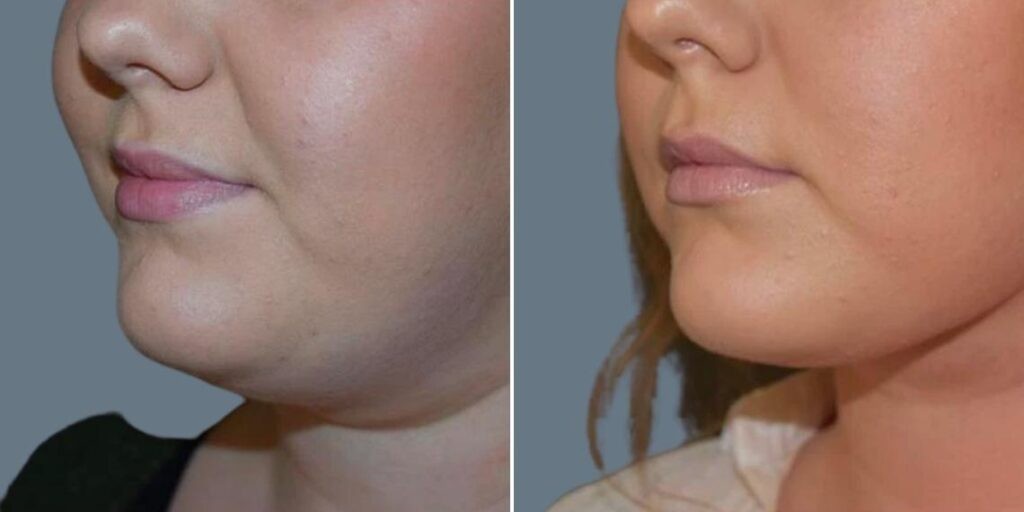 Skin Neck Liposuction Lift Female Pre2024 008 Before And After
