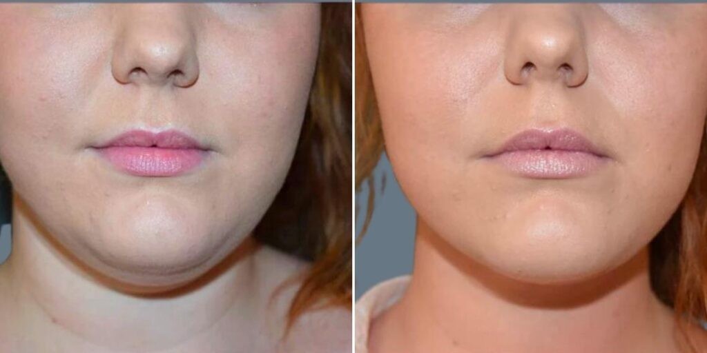 Skin Neck Liposuction Lift Female Pre2024 009 Before And After