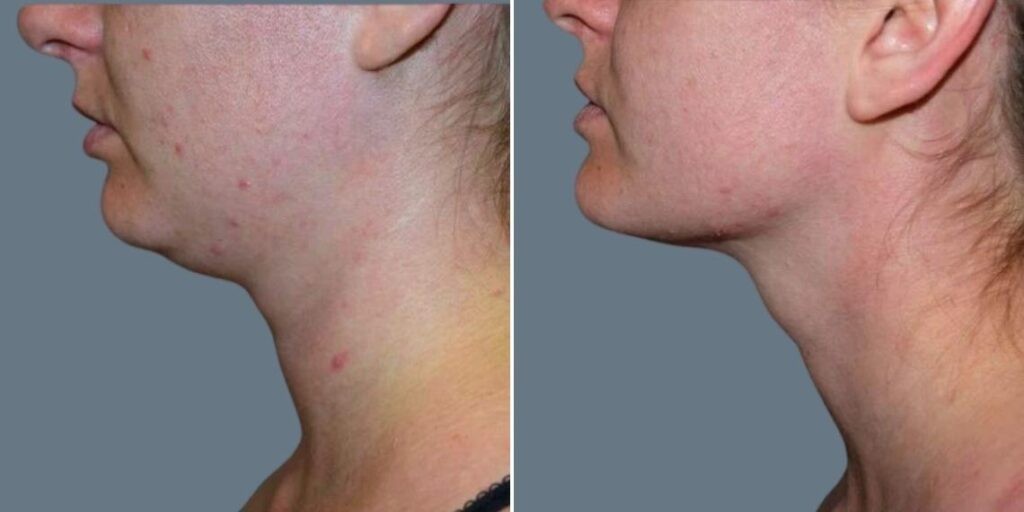 Skin Neck Liposuction Lift Female Pre2024 010 Before And After
