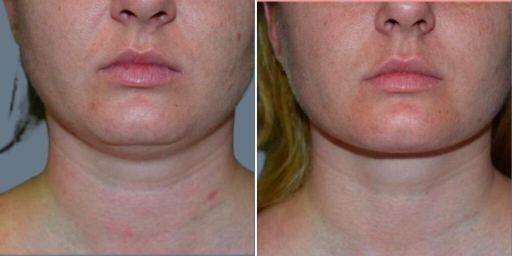 Skin Neck Liposuction Lift Female Pre2024 012 Before And After