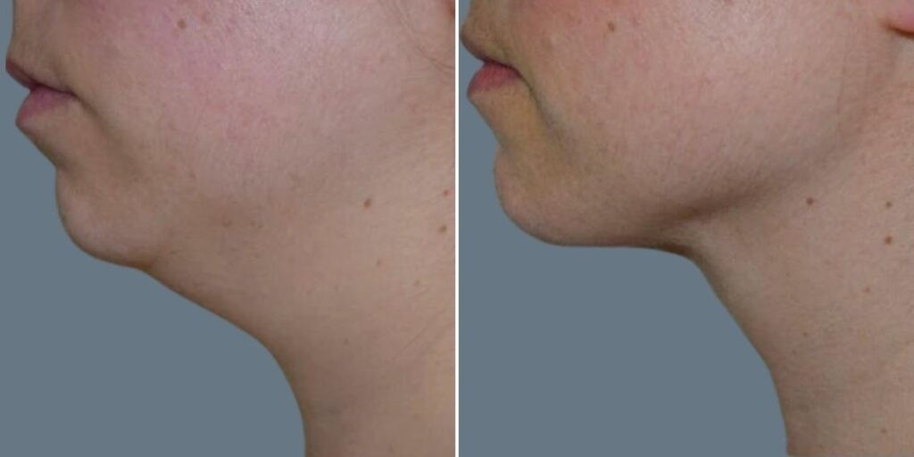 Skin Neck Liposuction Lift Female Pre2024 013 Before And After