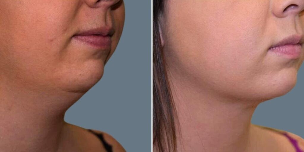 Skin Neck Liposuction Lift Female Pre2024 014 Before And After
