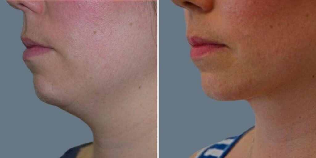 Skin Neck Liposuction Lift Female Pre2024 015 Before And After