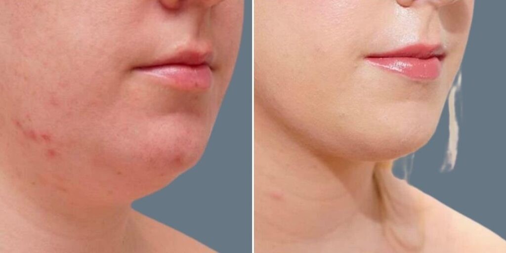 Skin Neck Liposuction Lift Female Pre2024 016 Before And After