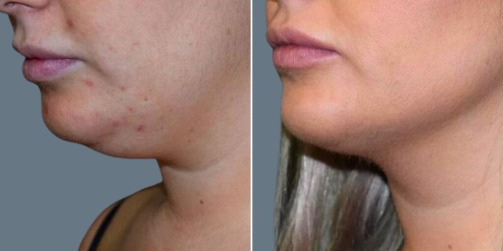 Skin Neck Liposuction Lift Female Pre2024 018 Before And After