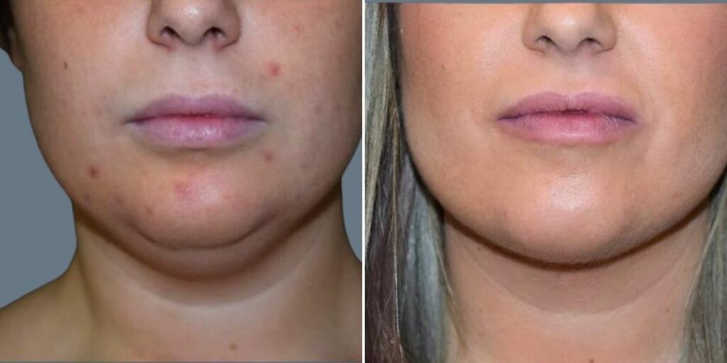 Skin Neck Liposuction Lift Female Pre2024 019 Before And After