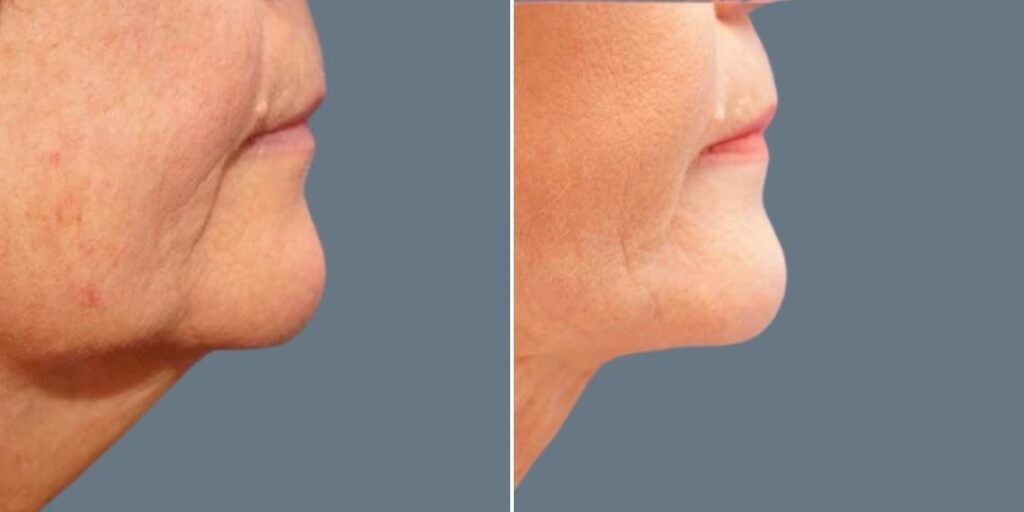 Skin Neck Liposuction Lift Female Pre2024 022 Before And After