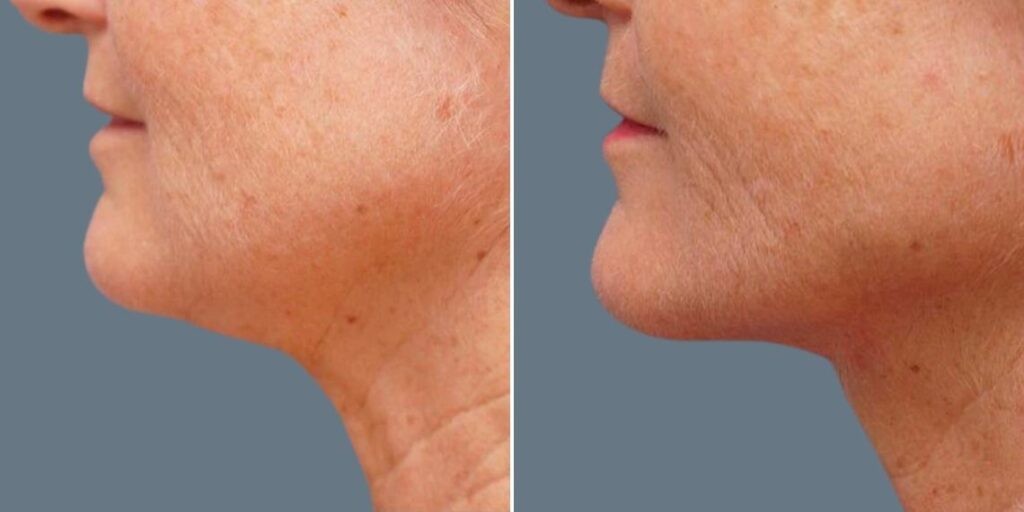 Skin Neck Liposuction Lift Female Pre2024 023 Before And After