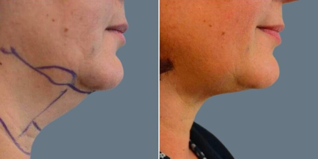 Skin Neck Liposuction Lift Female Pre2024 024 Before And After