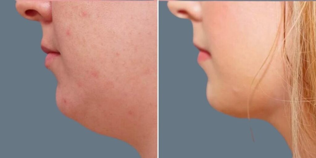 Skin Neck Liposuction Lift Female Pre2024 026 Before And After