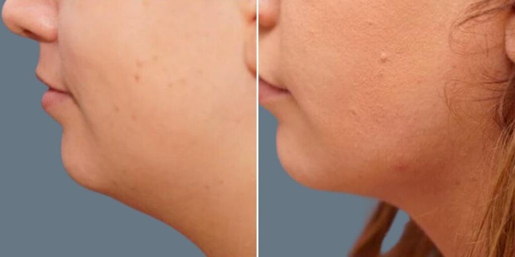 Skin Neck Liposuction Lift Female Pre2024 027 Before And After