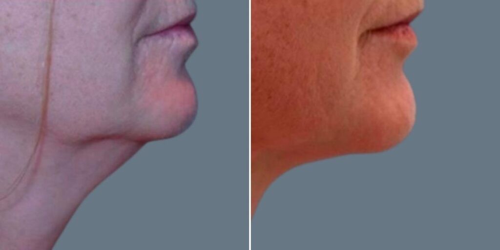 Skin Neck Liposuction Lift Female Pre2024 028 Before And After