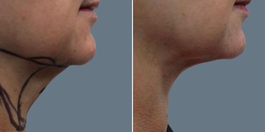 Skin Neck Liposuction Lift Female Pre2024 029 Before And After