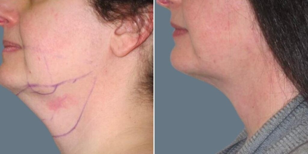 Skin Neck Liposuction Lift Female Pre2024 030 Before And After